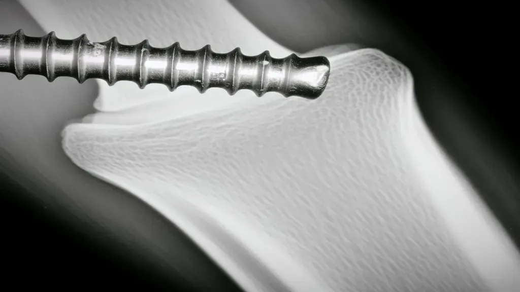 Jak długo goją się kości po wyjęciu śrub?